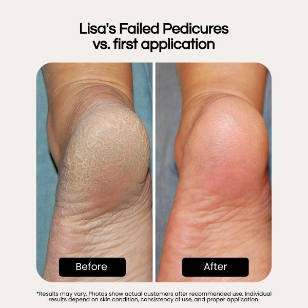 Bryft Heel Therapy+